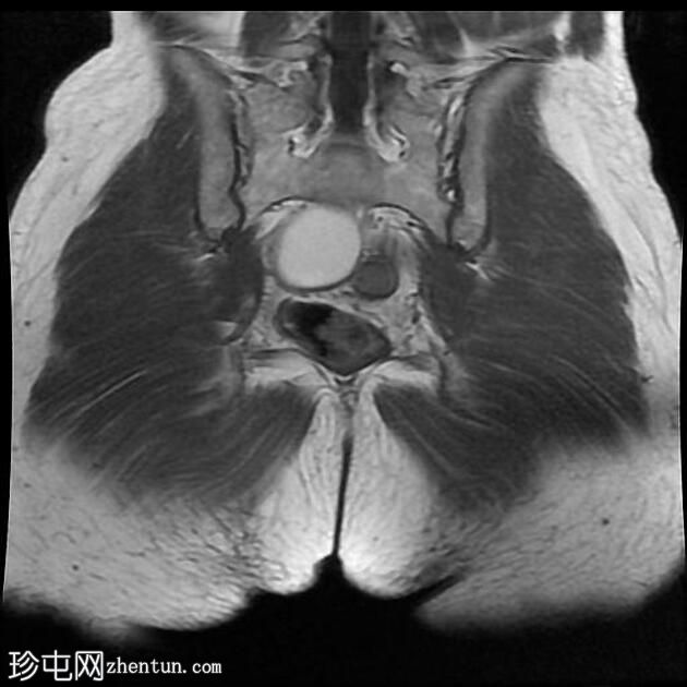 子宫内膜异位症 - T2 阴影征