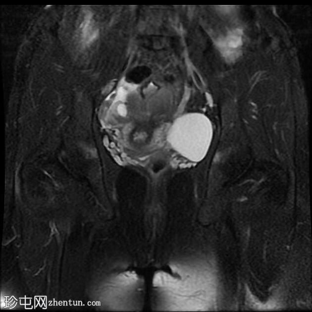 子宫内膜异位症 - T2 阴影征