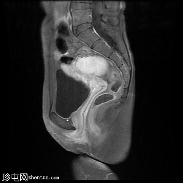 子宫内膜异位症 - T2 阴影征