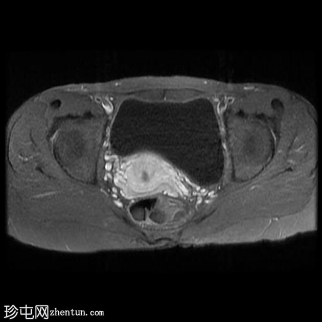 子宫内膜异位症 - T2 阴影征