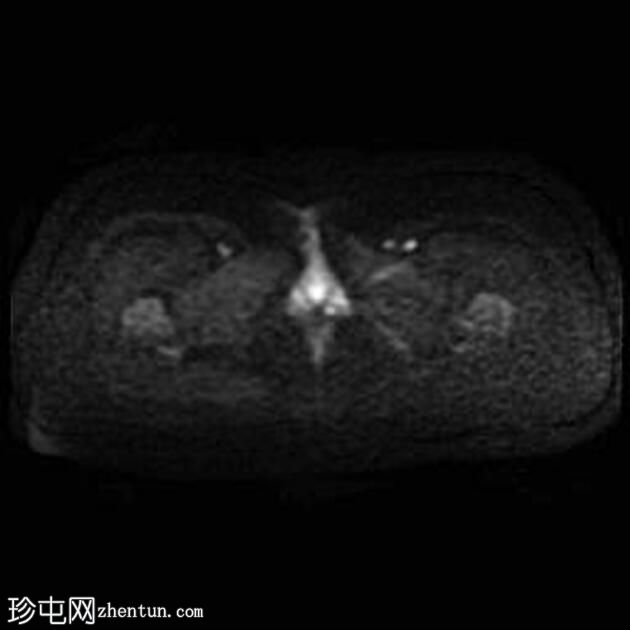 子宫内膜异位症 - T2 阴影征