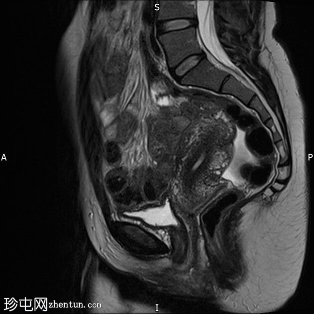 卵巢皮样囊肿