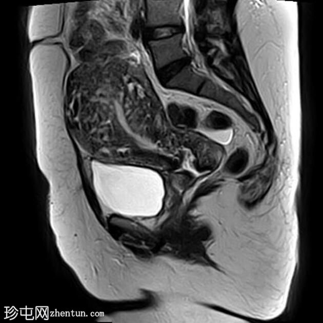 弥漫性子宫腺肌病伴腹膜下受累