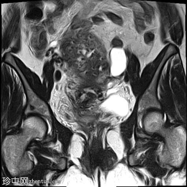 弥漫性子宫腺肌病伴腹膜下受累