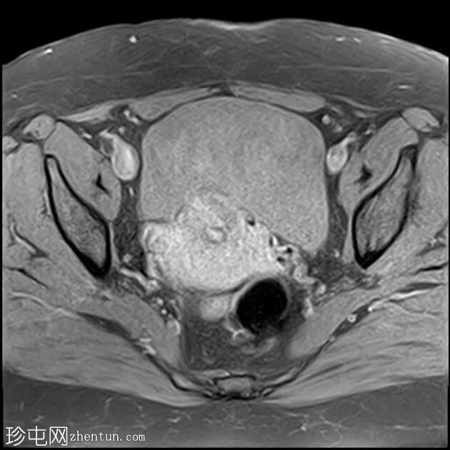 弥漫性子宫腺肌病伴腹膜下受累