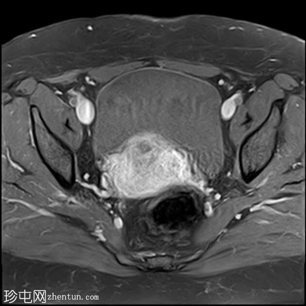 弥漫性子宫腺肌病伴腹膜下受累