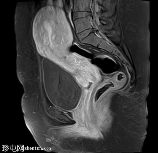 弥漫性子宫腺肌病伴腹膜下受累