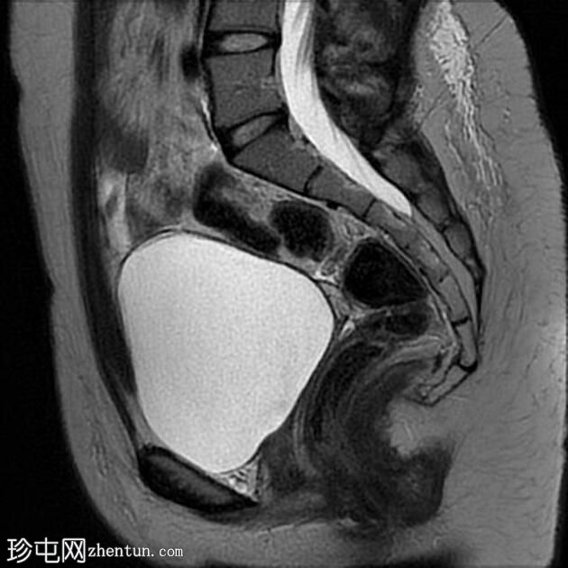 患有子宫角发育不全的 Mayer-Rokitansky-Küster-Hauser 综合征 (MRKH)