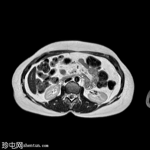 胰腺内门管海绵状瘤