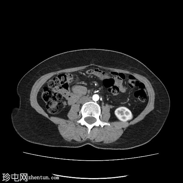 胰腺内门管海绵状瘤