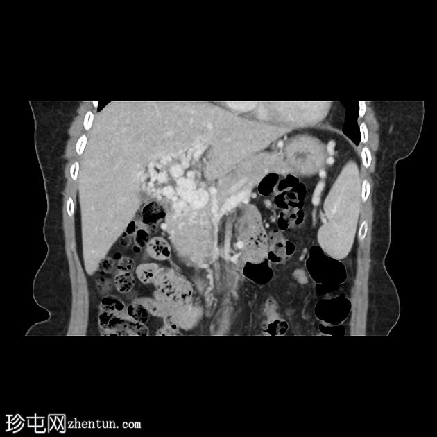 胰腺内门管海绵状瘤