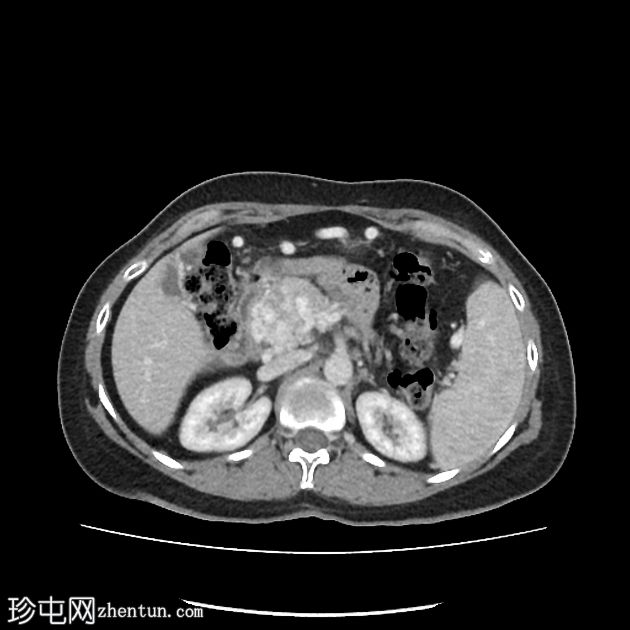 胰腺内门管海绵状瘤