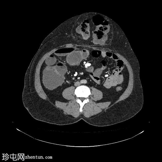 阻塞性腹壁疝