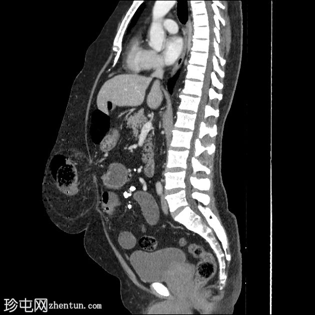 阻塞性腹壁疝