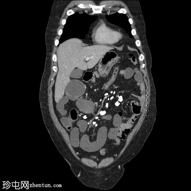 阻塞性腹壁疝