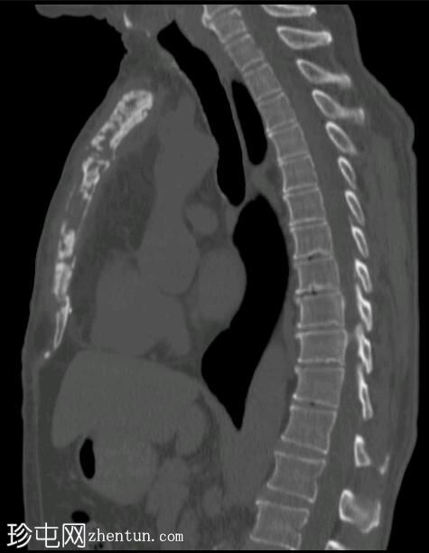 胸骨切开术-骨髓炎