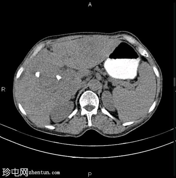 转移性胆囊腺癌