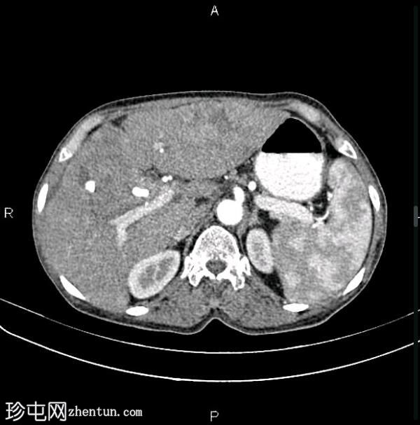 转移性胆囊腺癌