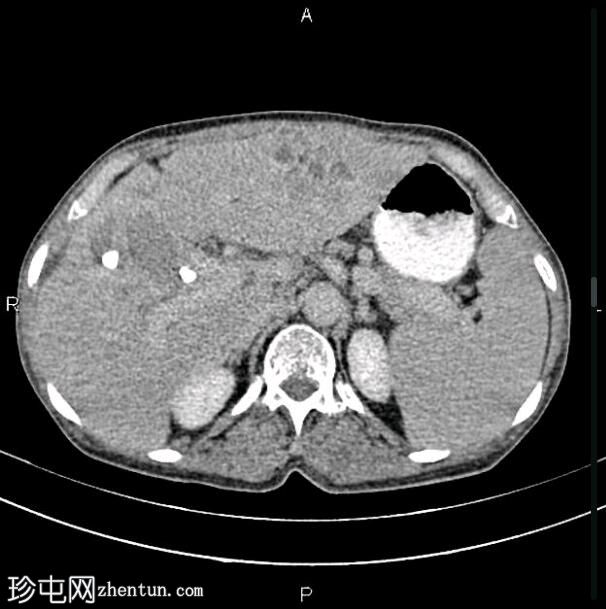 转移性胆囊腺癌