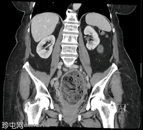 粪石性结肠炎