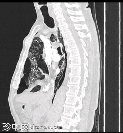 结核病并发支气管肺瘘及肺栓塞