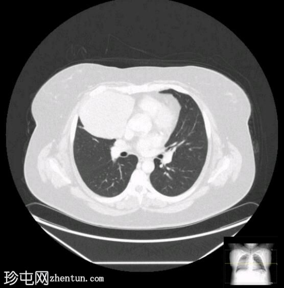 伴有肺门重叠征的前纵隔肿块