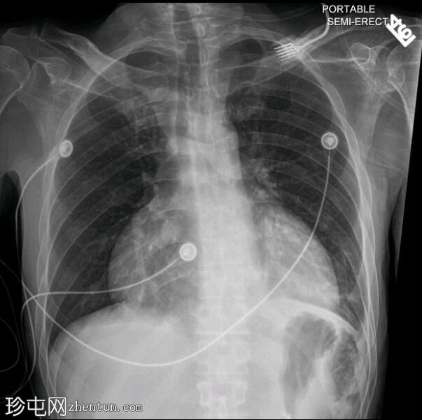 食管癌致食管心包瘘