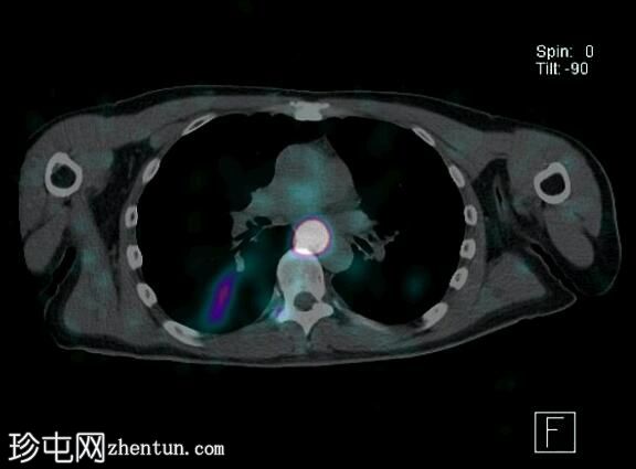 核医学抽吸 SPECT 研究阳性