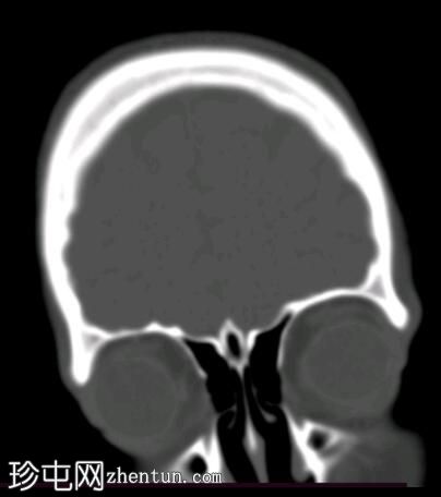 颈鼓室副神经节瘤和乳突炎伴颅内感染