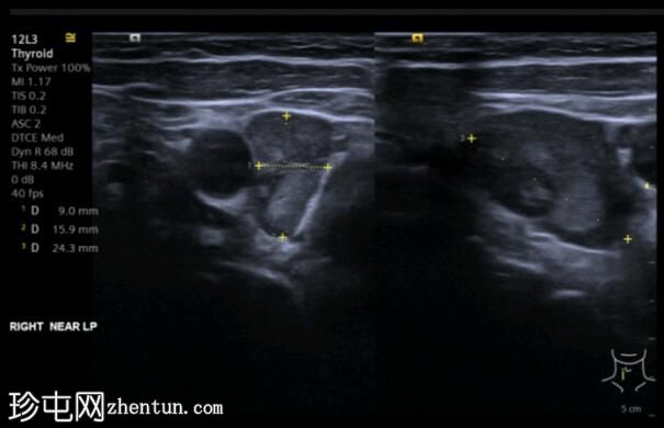 乳头状甲状腺癌并发甲状旁腺腺瘤