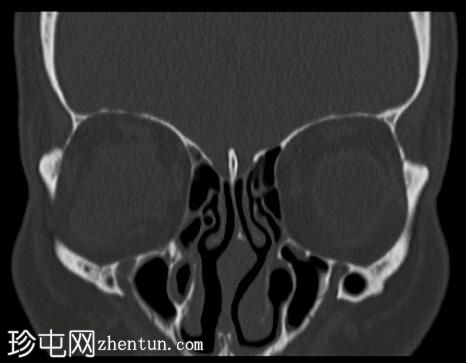 眼眶海绵状静脉畸形