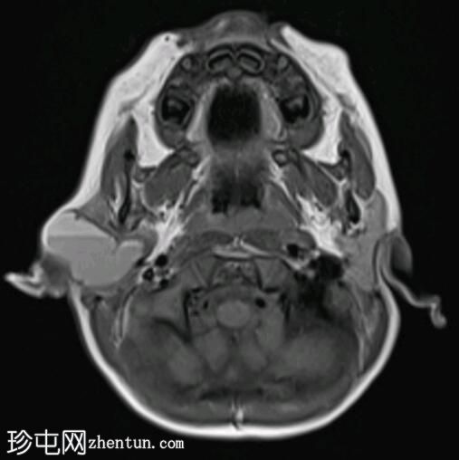 新生儿腮腺淋巴管畸形