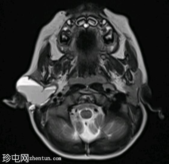 新生儿腮腺淋巴管畸形