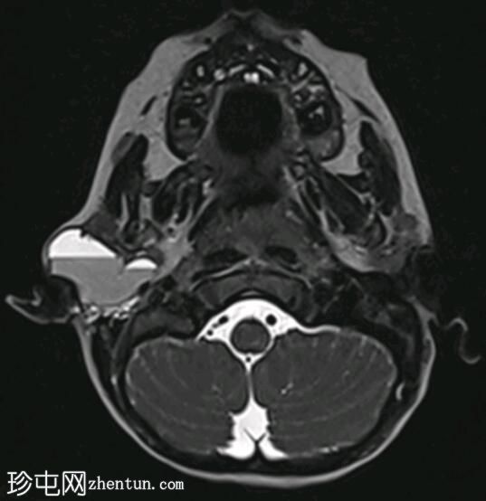 新生儿腮腺淋巴管畸形