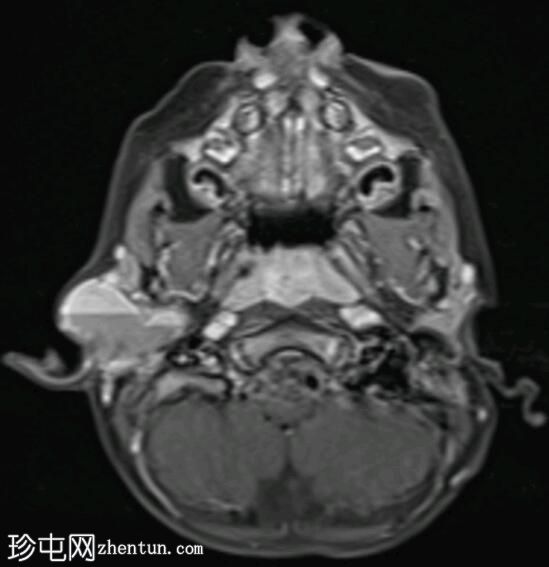 新生儿腮腺淋巴管畸形