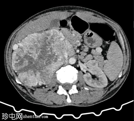 伴有多系统转移性扩散的肾细胞癌