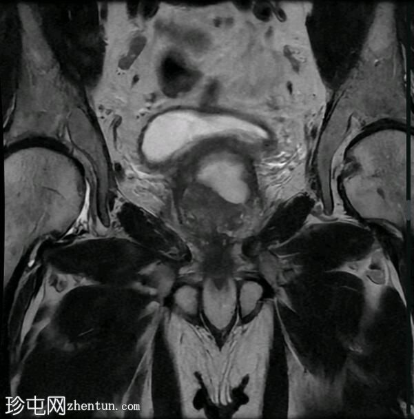 前列腺脓肿和 BPH