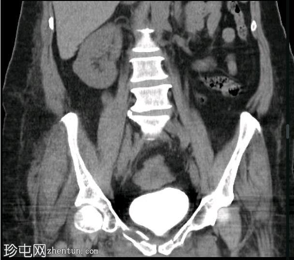 膀胱CT造影正常值