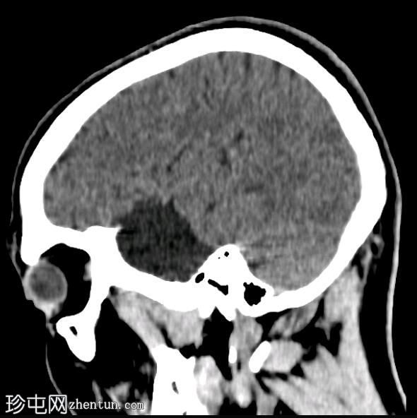 中颅窝蛛网膜囊肿和蝶窦气窦扩张