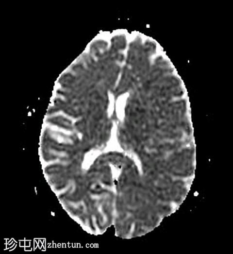 亚急性硬膜下出血（MRI）