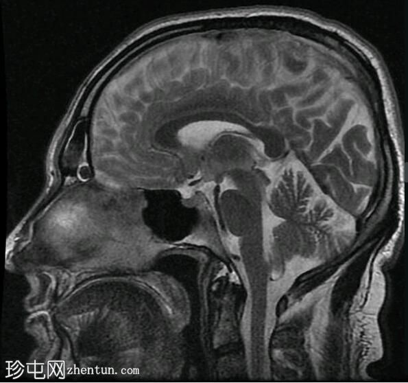 亚急性硬膜下出血（MRI）