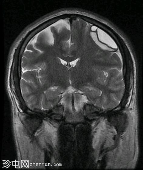 亚急性硬膜下出血（MRI）