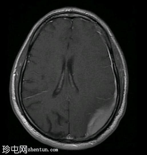 亚急性硬膜下出血（MRI）