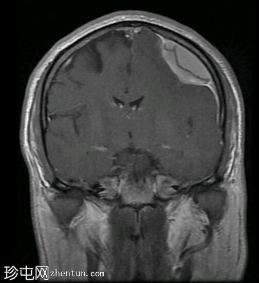 亚急性硬膜下出血（MRI）