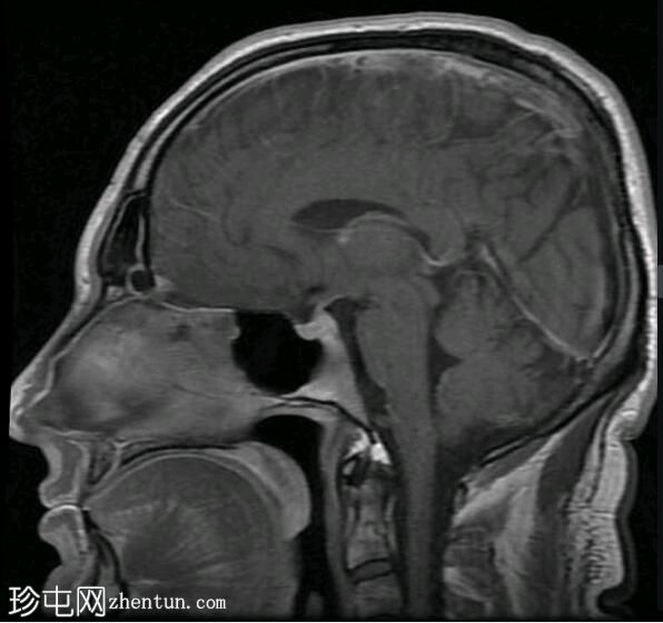 亚急性硬膜下出血（MRI）