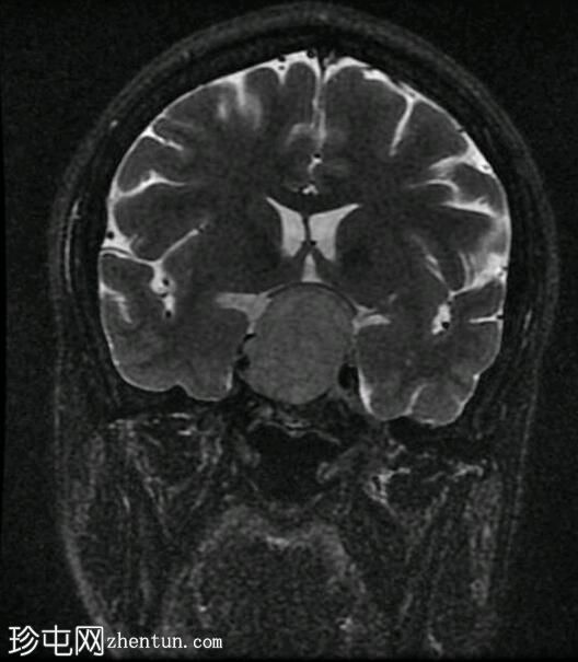 垂体大腺瘤