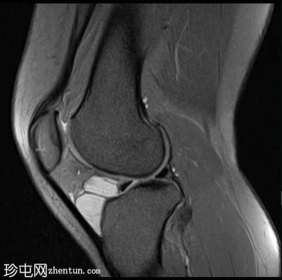 霍法脂肪垫腱鞘囊肿