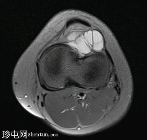 霍法脂肪垫腱鞘囊肿