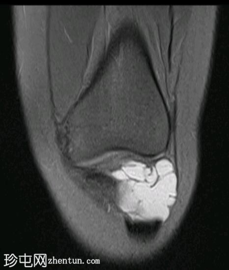 霍法脂肪垫腱鞘囊肿