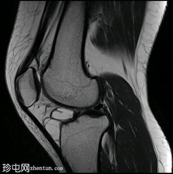 霍法脂肪垫腱鞘囊肿